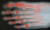 Symptoms of Psoriatic Arthritis in the Feet