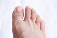 How to Deal With an Ingrown Toenail 