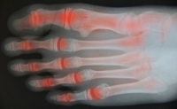 Arthritis Can Affect the Toes
