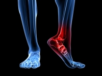 A Calcaneal Stress Fracture Means a Broken Heel Bone